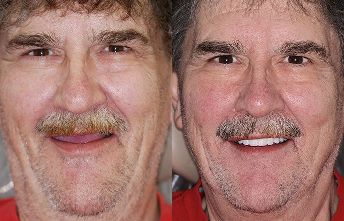 HidoneĀ® Full Denture Setš¦·Advanced Self-Adjusting Dental Materials (ā°Limited time discount last 30 minutesā°)