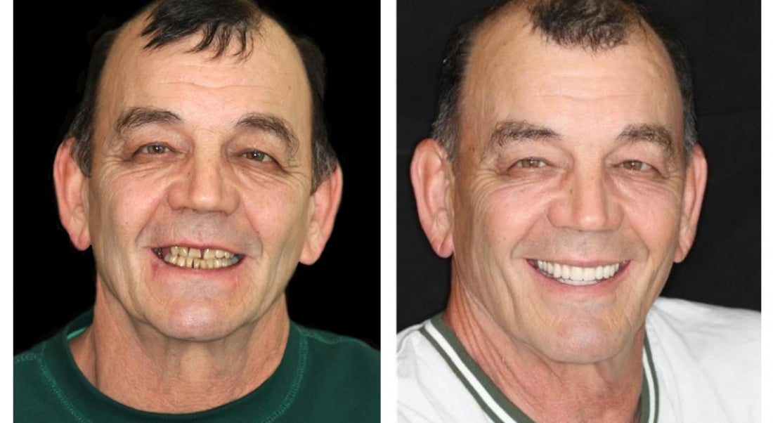 HidoneĀ® Full Denture Setš¦·Advanced Self-Adjusting Dental Materials (ā°Limited time discount last 30 minutesā°)