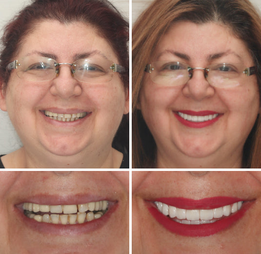 HidoneĀ® Full Denture Setš¦·Advanced Self-Adjusting Dental Materials (ā°Limited time discount last 30 minutesā°)