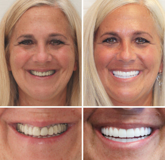 HidoneĀ® Full Denture Setš¦·Advanced Self-Adjusting Dental Materials (ā°Limited time discount last 30 minutesā°)