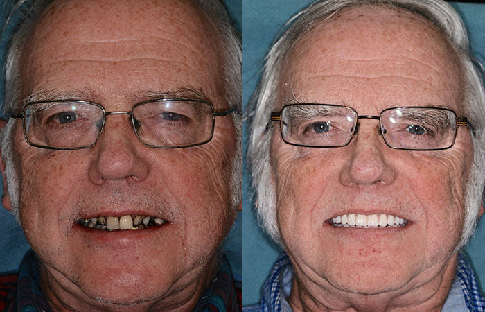 Hidone® Full Denture Set🦷Advanced Self-Adjusting Dental Materials (⏰Limited time discount last 30 minutes⏰)