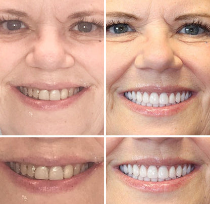Hidone® Full Denture Set🦷Advanced Self-Adjusting Dental Materials (⏰Limited time discount last 30 minutes⏰)