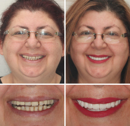 Hidone® Full Denture Set🦷Advanced Self-Adjusting Dental Materials (⏰Limited time discount last 30 minutes⏰)